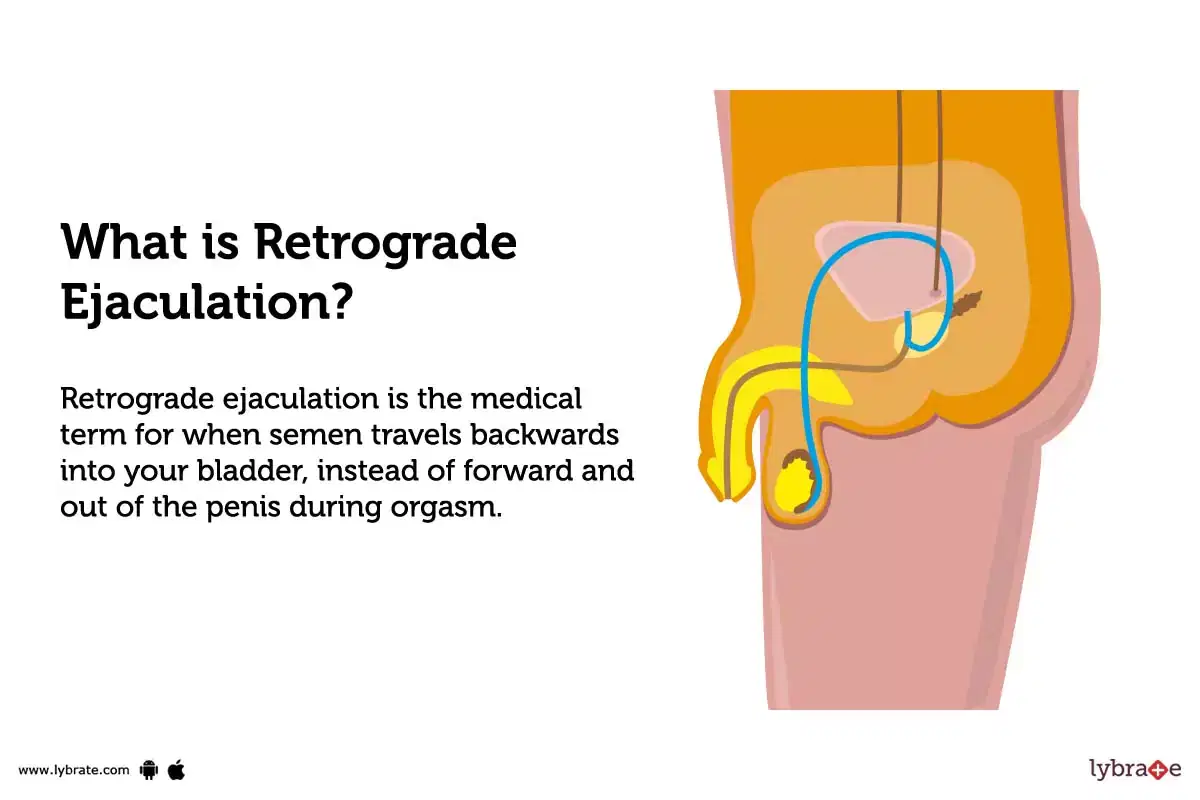 Injaculation: What You Need to Know About Retrograde Ejaculation