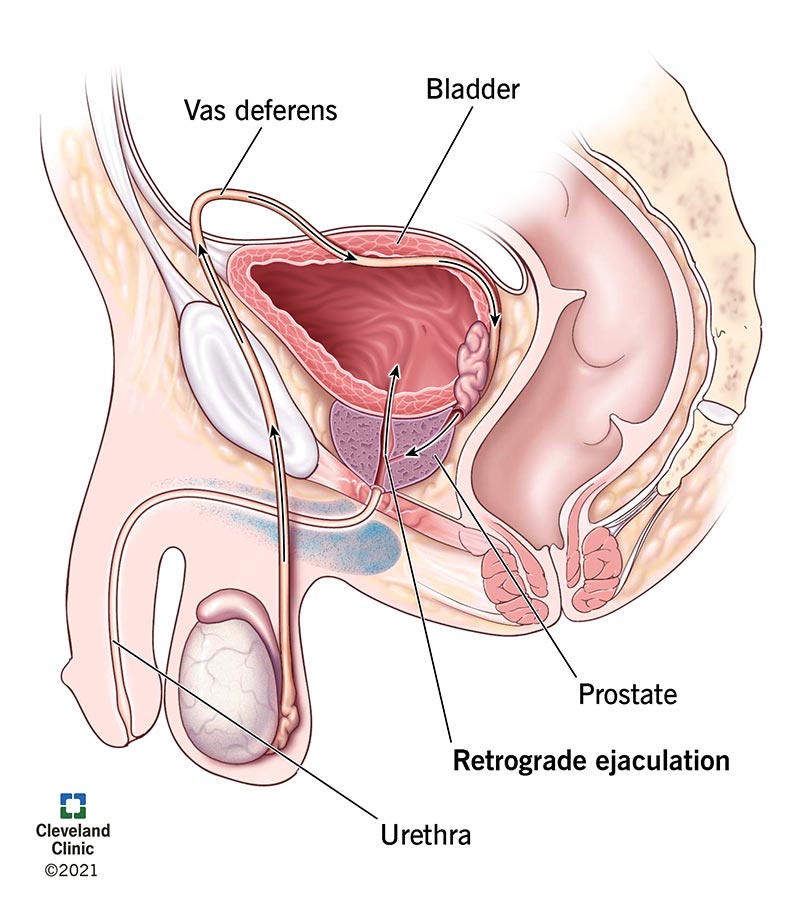 Injaculation: What You Need to Know About Retrograde Ejaculation