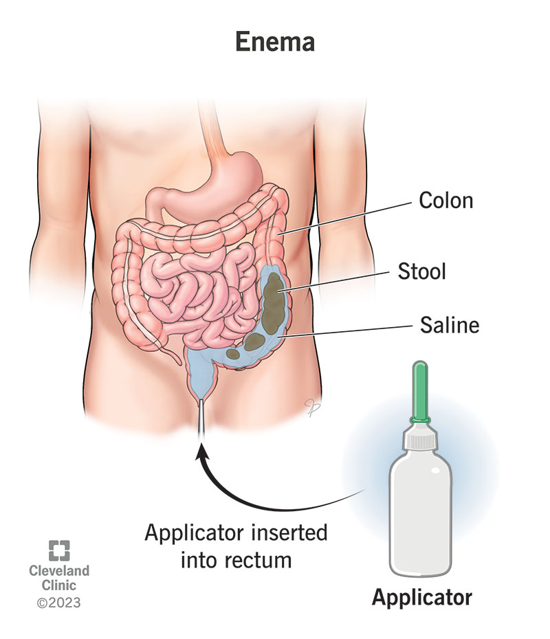 Exploring Enema Play: Benefits, Risks, and What to Expect